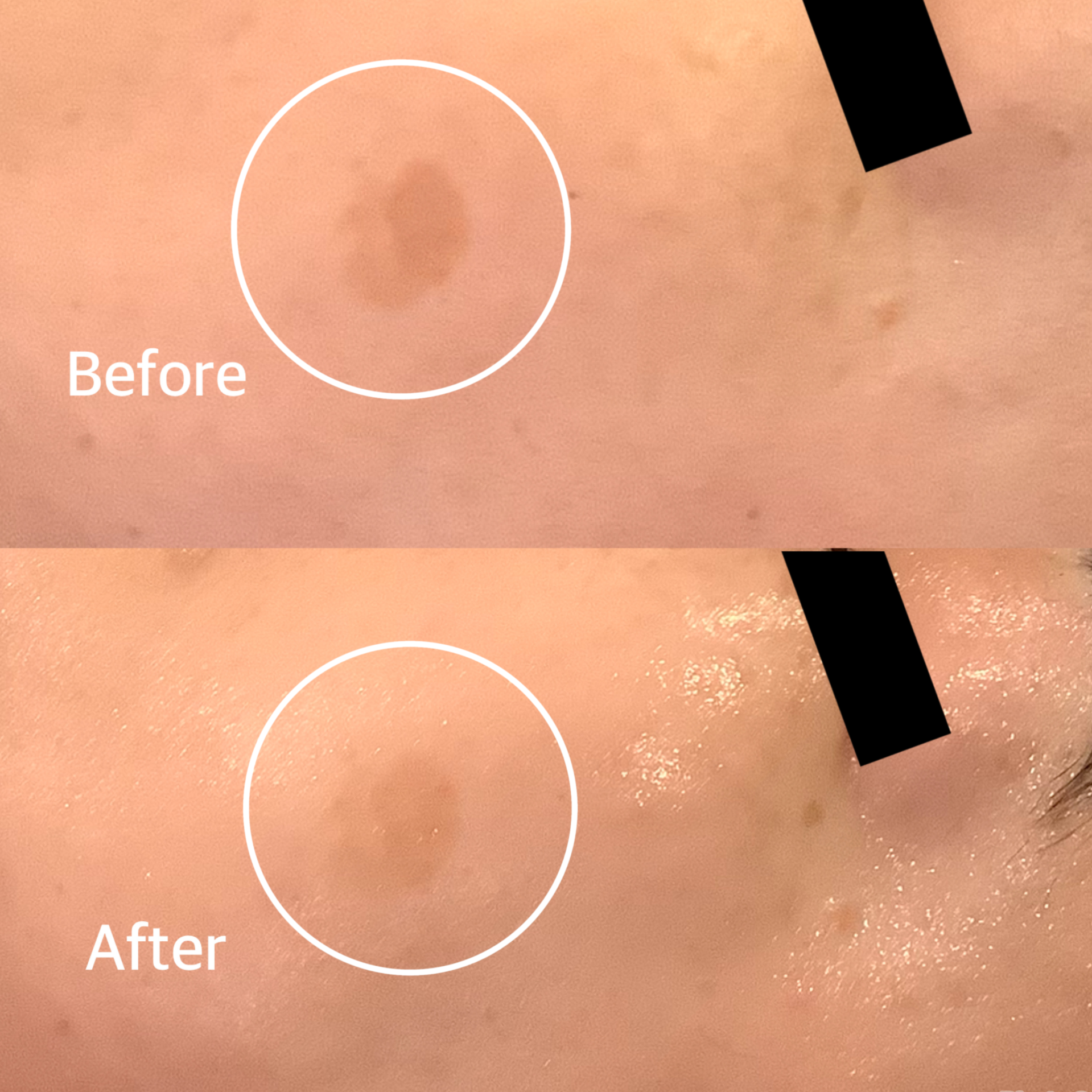 シミ取りエステ　シミ取りたい